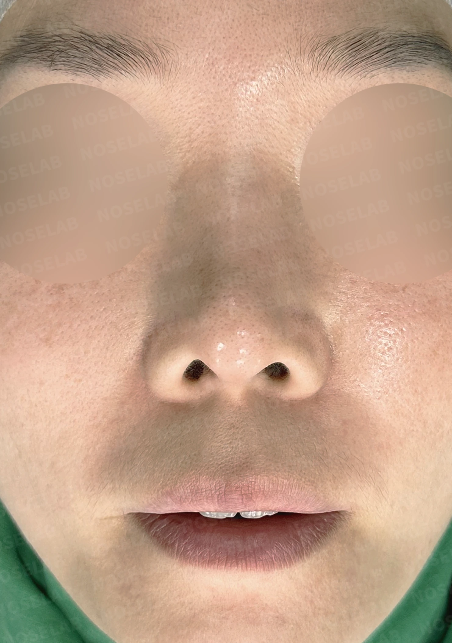 오래된 코성형 뒤 코끝이 들리고 콧구멍이 드러나는 이유, 제거와 자가진피 재건은 어떻게 하나 — 수술 전 / 수술 직후 0일 직후 사진은 부기가 있는 상태로 최종 결과와 다를 수 있습니다.