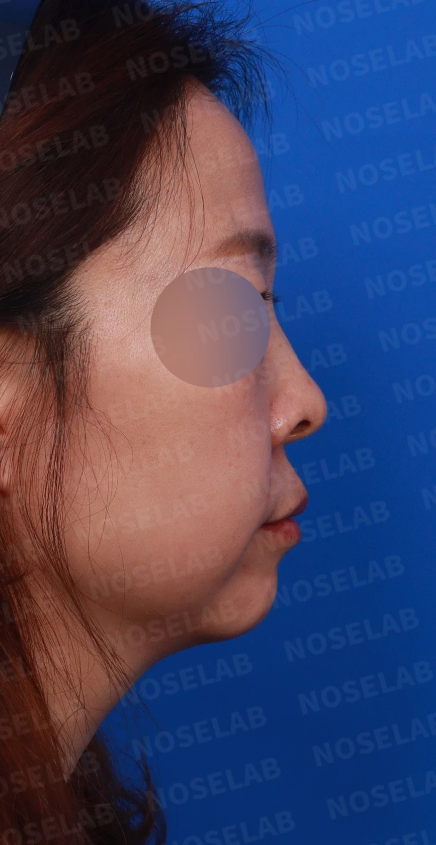 들창코에서 콧구멍이 많이 보이는 이유, 코끝 위치 교정은 어떻게 하나 — 디자인 상담 우측 비스듬한 측면, 측면, 비공 사진