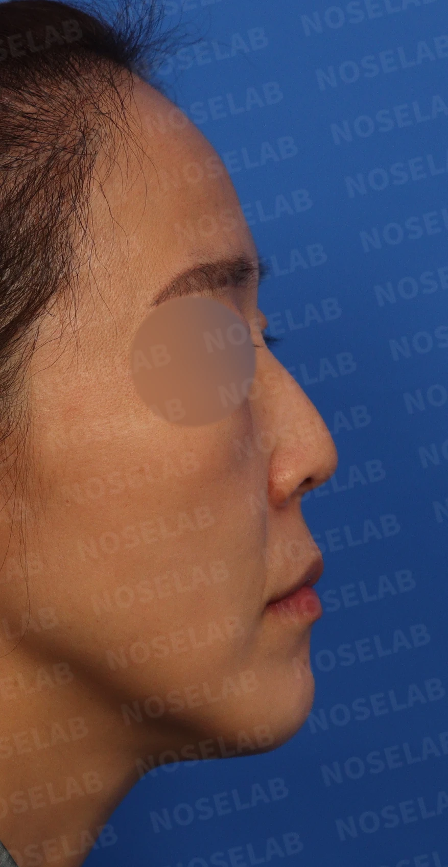들창코, 매부리코, 휜코까지 한번에 완벽 교정! — 수술전 디자인 상담 우측 측면, 비스듬한 측면, 비공 사진입니다.