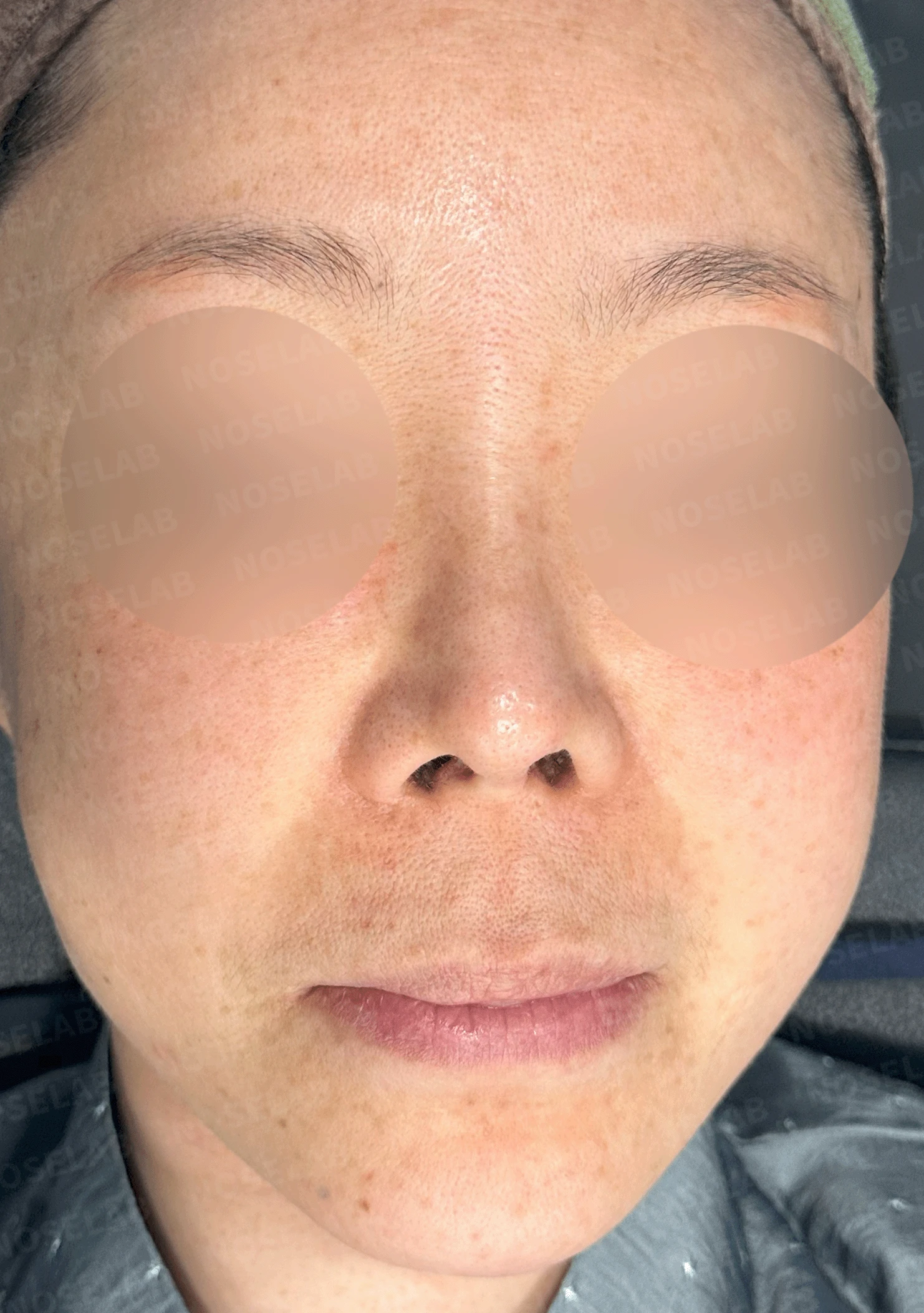 코가 짧고 들리며 비주가 함몰되는 이유, 자가 늑연골 재건은 어떻게 하나 — 본문 사진 8