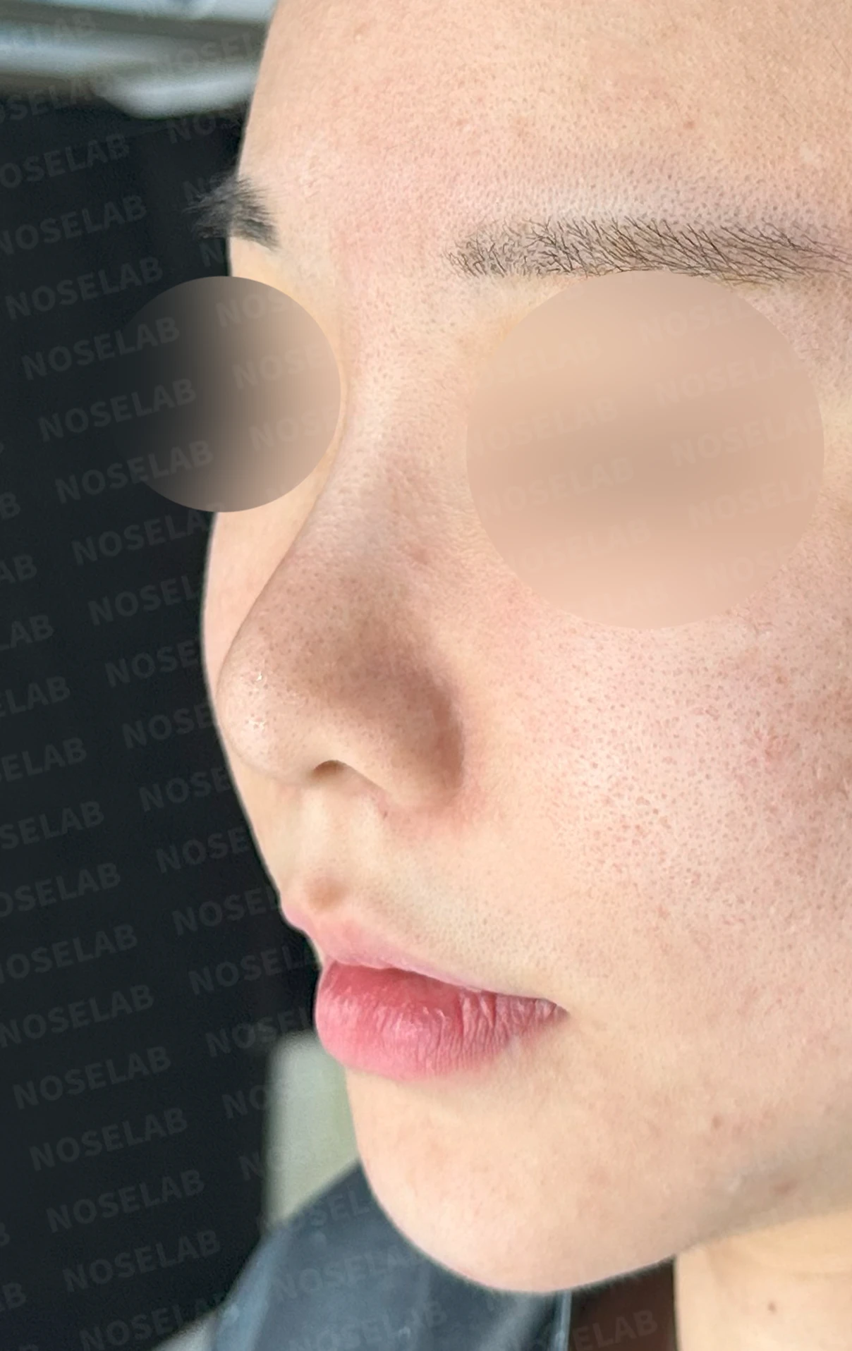 필러와 실 시술 뒤 코가 뭉툭해지는 이유, 이물질 제거와 코끝 교정 방법 — 수술 전 / 수술 직후 0일 직후 사진은 부기가 있는 상태로 최종 결과와 다를 수 있습니다.