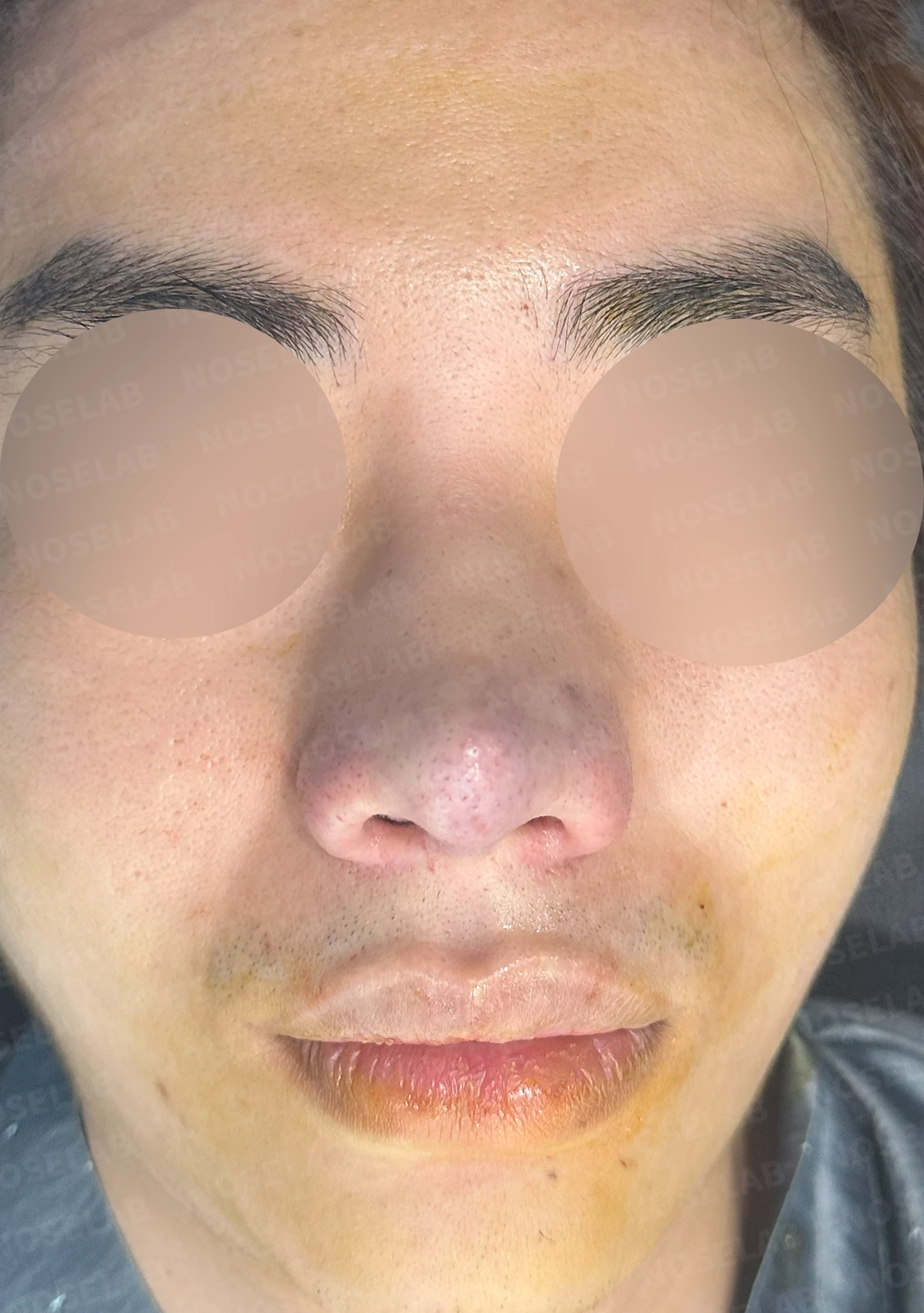 코뼈 골절에 미용 수술을 함께 할 수 있는 경우와 단계로 나누는 방법 — 수술 직후 0일 정면, 측면, 비스듬한 측면 사진 직후 사진은 부기가 있는 상태로 최종 결과와 다를 수 있습니다.