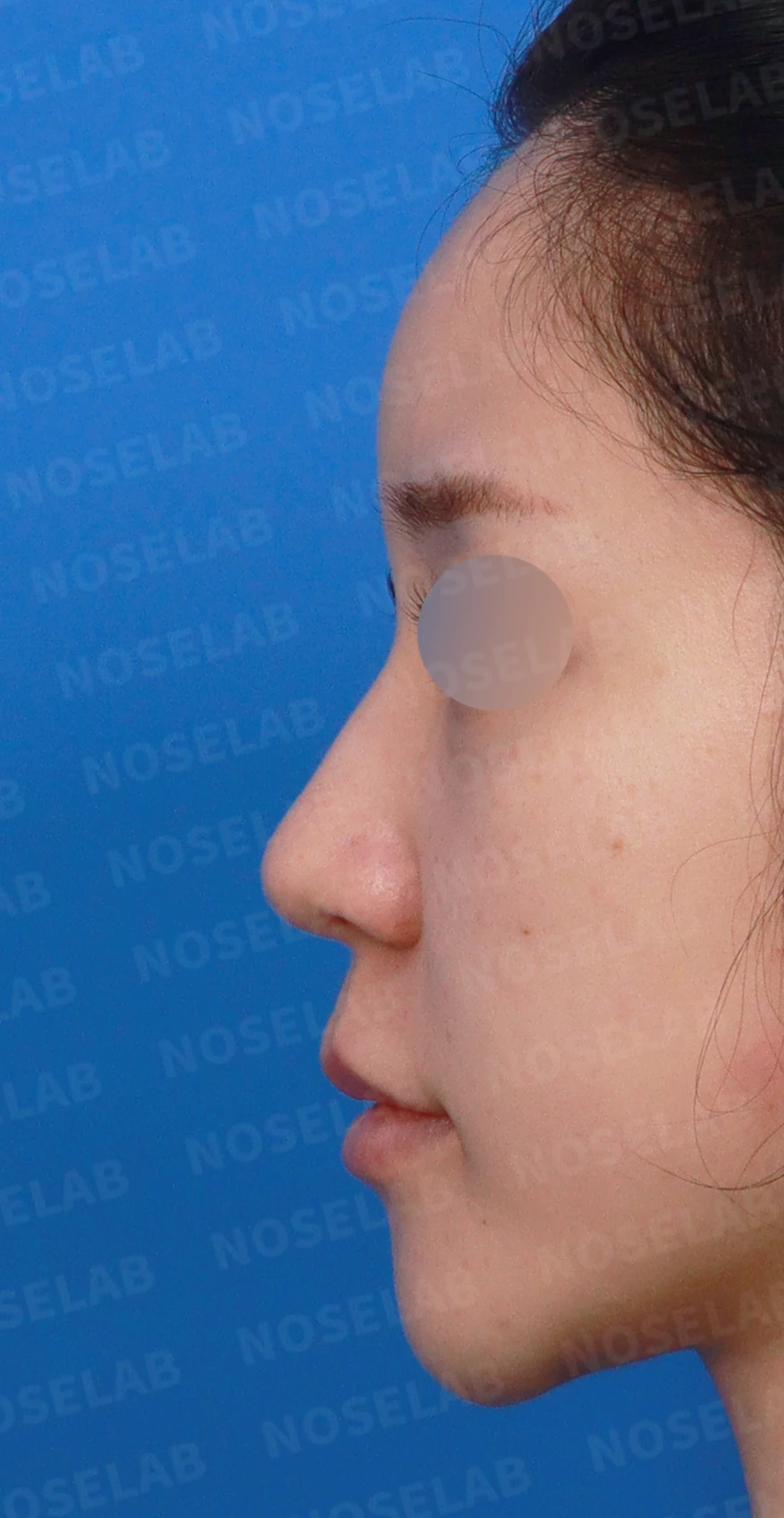 복코가 뭉툭하고 퍼져 보이는 이유와 코끝 입체감을 만드는 방법 — 디자인 상담 정면, 좌측 측면, 비스듬한 측면 사진입니다