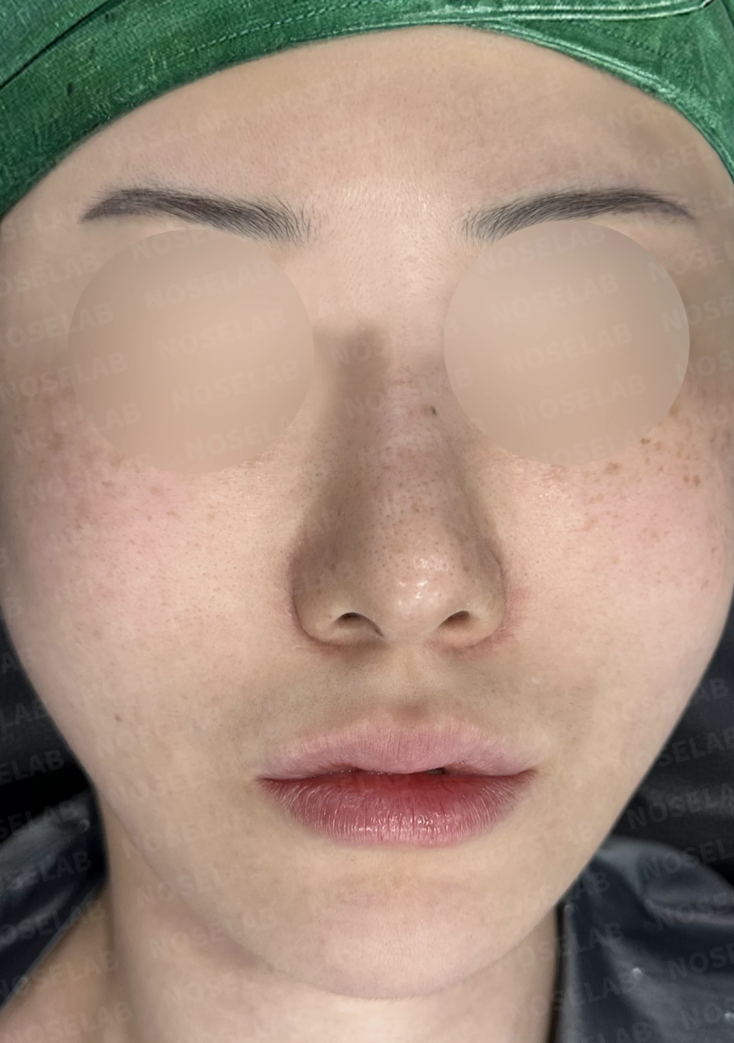 길고 뭉툭한 코, 자가늑연골로 화려하면서 자연스럽게 — 전(좌) , 직후(후)