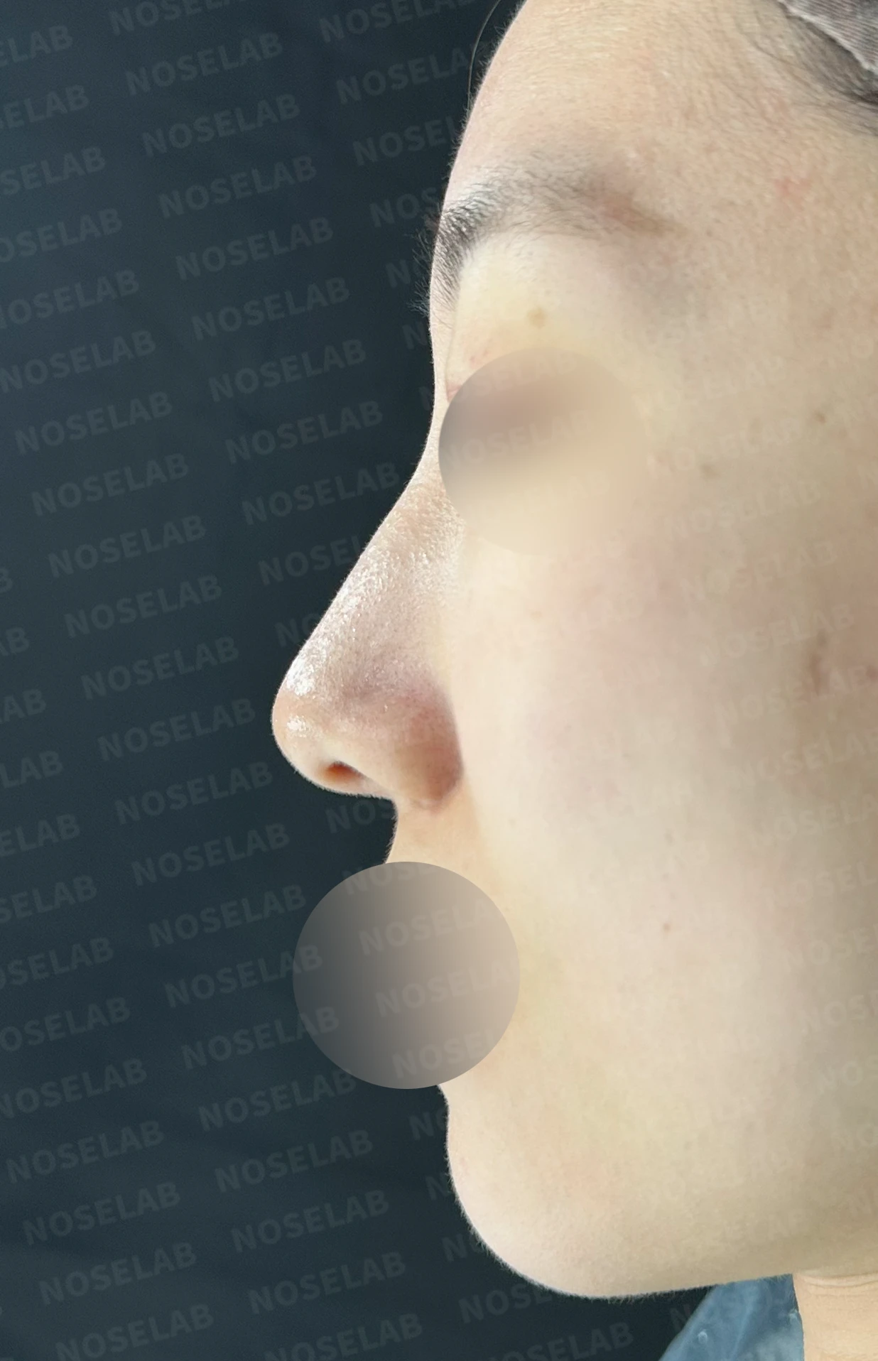 매부리를 정리한 뒤 콧등이 눌려 보이고 코끝이 뭉툭해지는 이유, 보형물 없이 교정하는 방법 — 수술 전 / 수술 직후 0일 직후 사진은 부기가 있는 상태로 최종 결과와 다를 수 있습니다.
