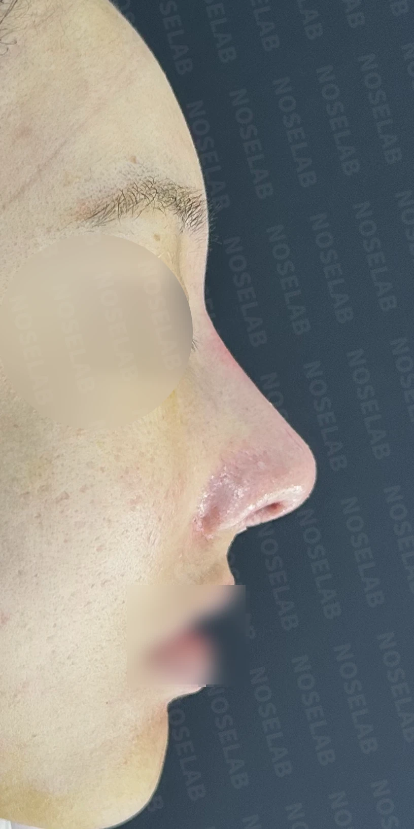 반복 수술 후 긴 코와 높은 시작점의 재수술 방법 — 수술 직후 0일 정면, 측면, 비스듬한 측면 직후 사진은 부기가 있는 상태로 최종 결과와 다를 수 있습니다.