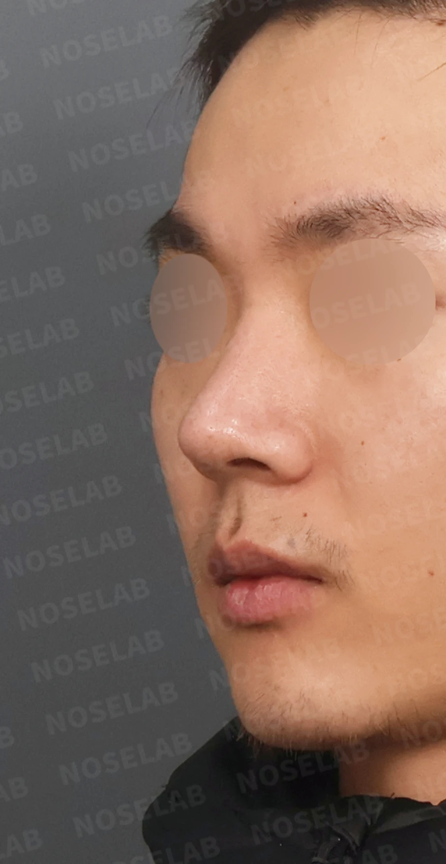 짧고 들린 코, 자가늑연골로 남성적인 라인으로 완성한 코재수술 — 디자인 상담 정면, 비스듬한 측면 , 측면 사진입니다.