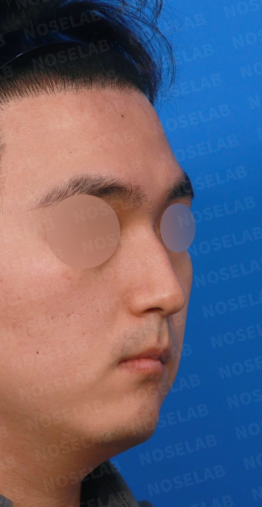 비중격이 휘면 코막힘과 휜 코가 함께 생기는 이유, 재건은 어떻게 하나 — 디자인 상담 우측 측면, 비스듬한 측면, 비공 사진입니다.