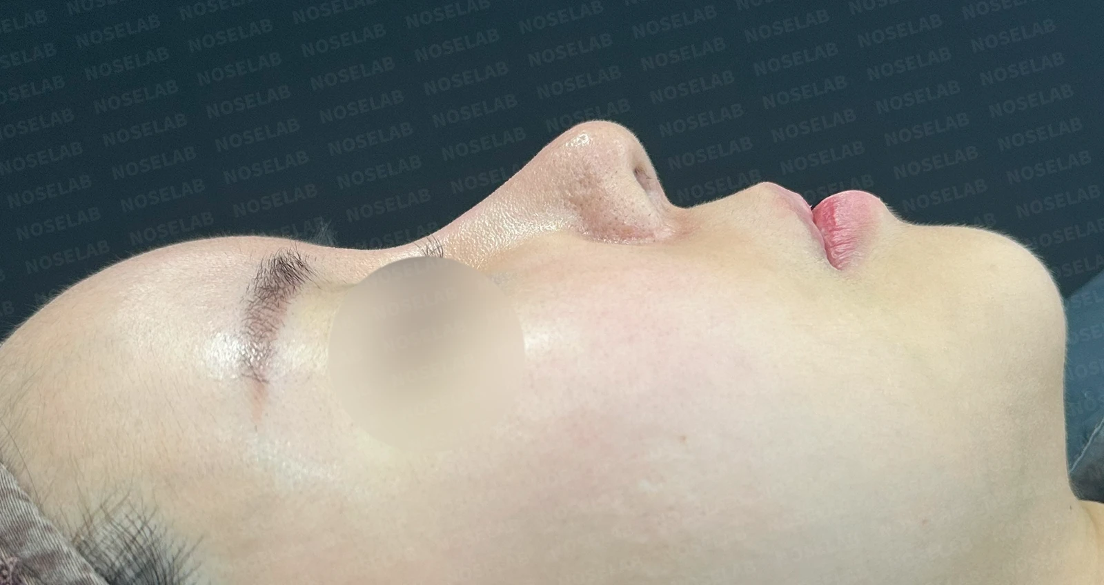 다섯 번의 수술 끝에 찾은 완벽한 코: 들린코와 휜코의 극적인 변신 — 수술전(좌) 수술직후(우)
