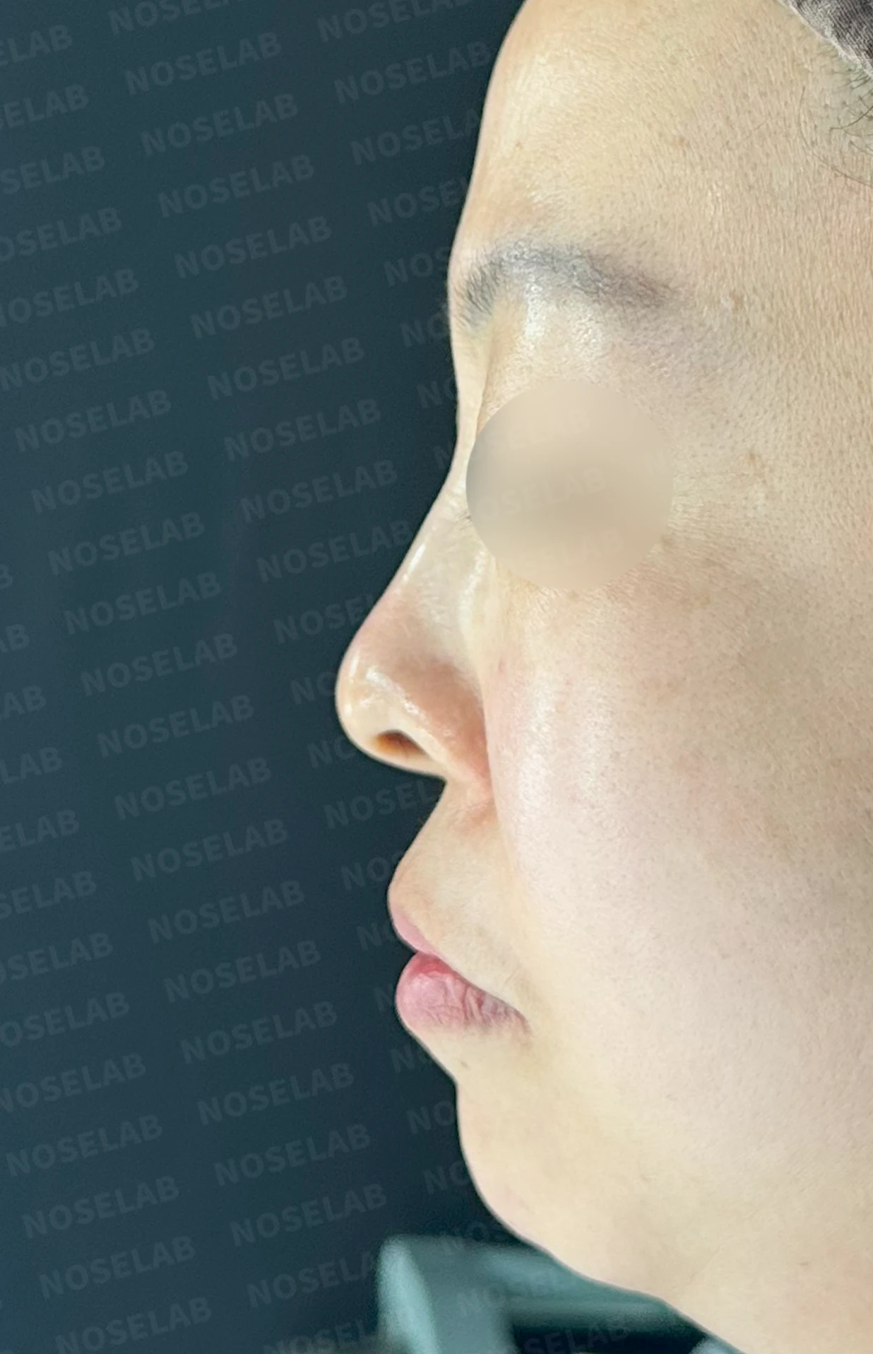 들창코에서 콧구멍이 많이 보이는 이유, 코끝 위치 교정은 어떻게 하나 — 수술 전 / 수술 직후 0일 직후 사진은 부기가 있는 상태로 최종 결과와 다를 수 있습니다.