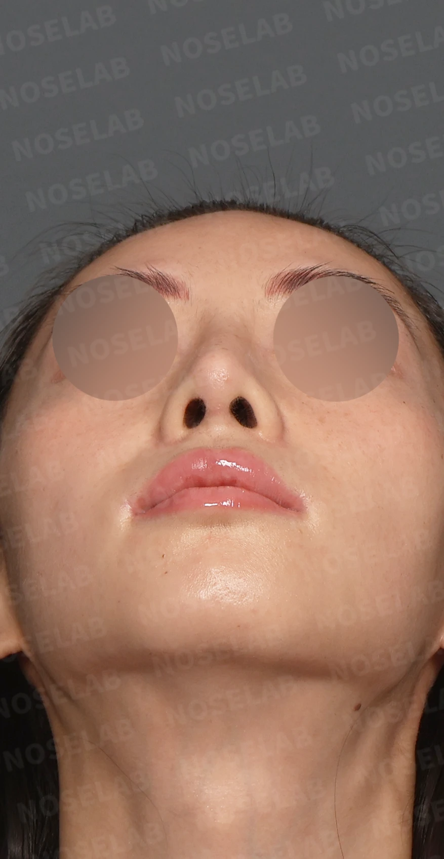 자가 늑연골 코재수술, 콧대부터 코끝까지 슬림하고 여성스럽게 — 디자인 상담 우측 측면, 비스듬한 측면, 비공 사진 입니다.