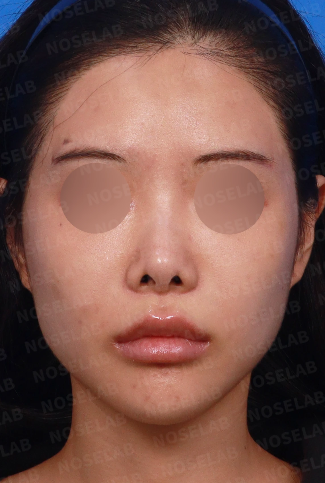 콧대 반영구 필러가 남기는 변화와 제거 후 비중격 재건 — 디자인 상담 정면, 좌측 측면, 비스듬한 측면 사진입니다.