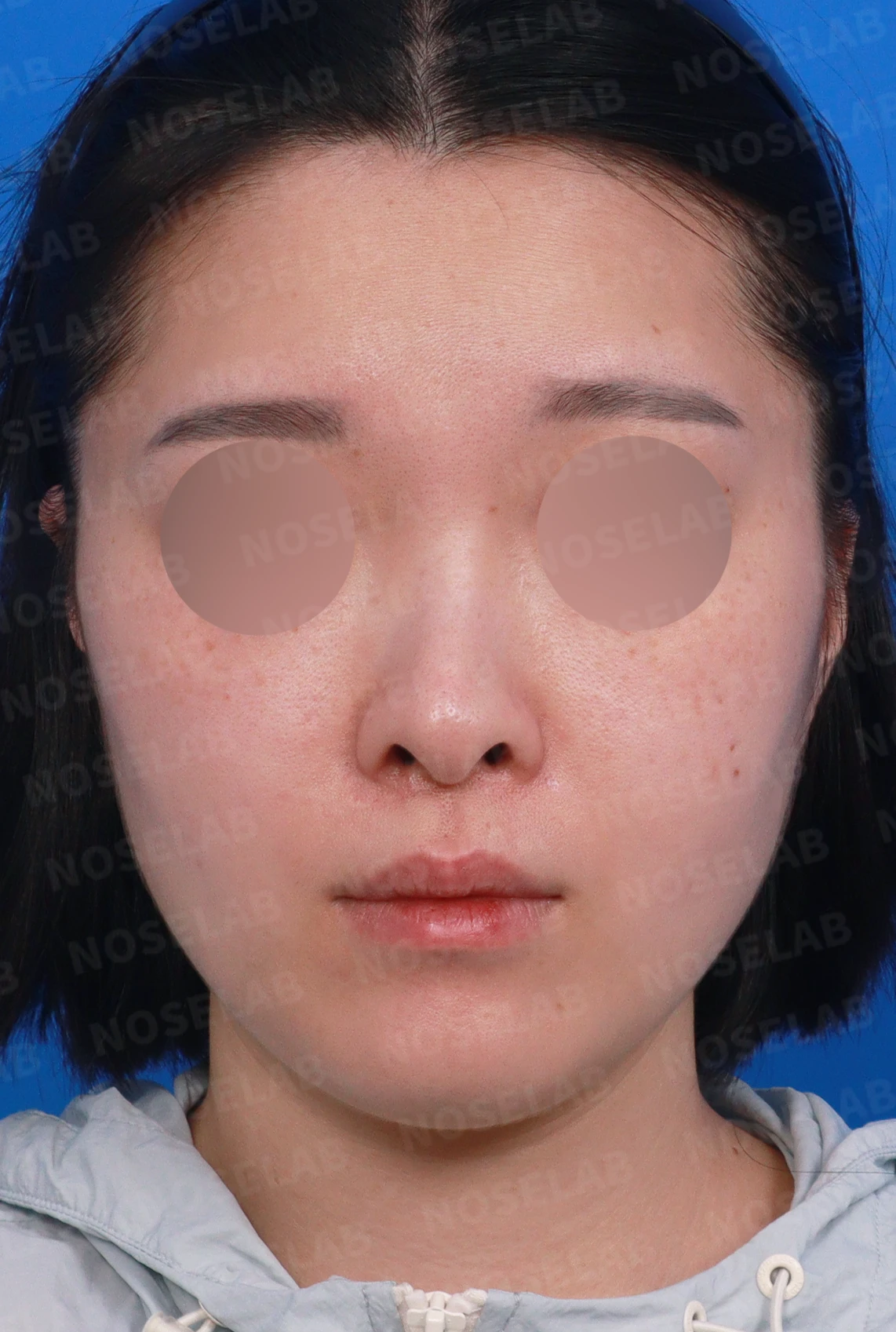 처진 비주 교정, 휜 코와 비공 비대칭까지 완벽하게 — 디자인 상담 정면, 좌측 측면, 비스듬한 측면 사진입니다.
