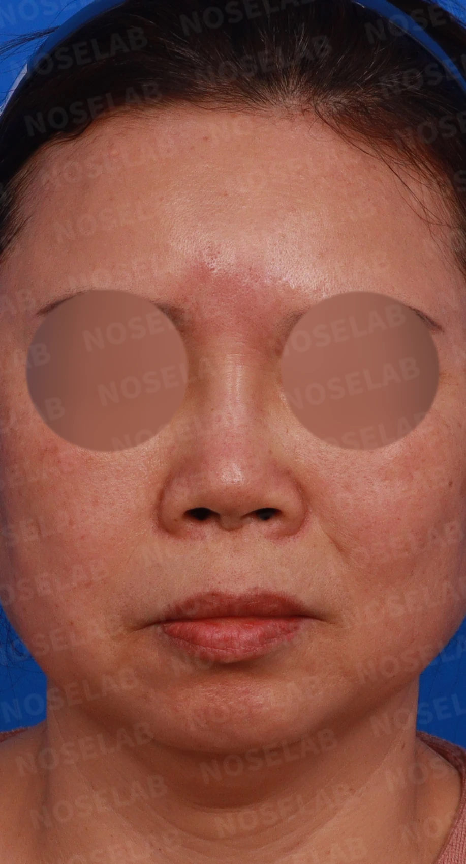 불법 주사 시술 뒤 코가 들리고 짧아지는 이유, 이물질 제거와 재건은 어떻게 하나 — 디자인 상담 정면, 좌측 측면, 비스듬한 측면 사진