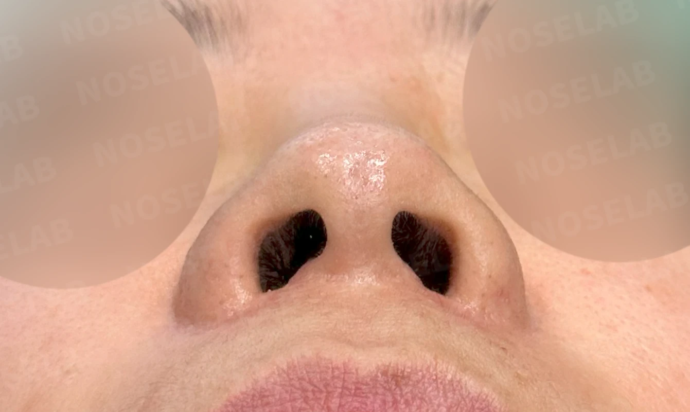 이물질제거후 코성형 방법 — 수술 전 / 수술 직후 0일 직후 사진은 부기가 있는 상태로 최종 결과와 다를 수 있습니다.