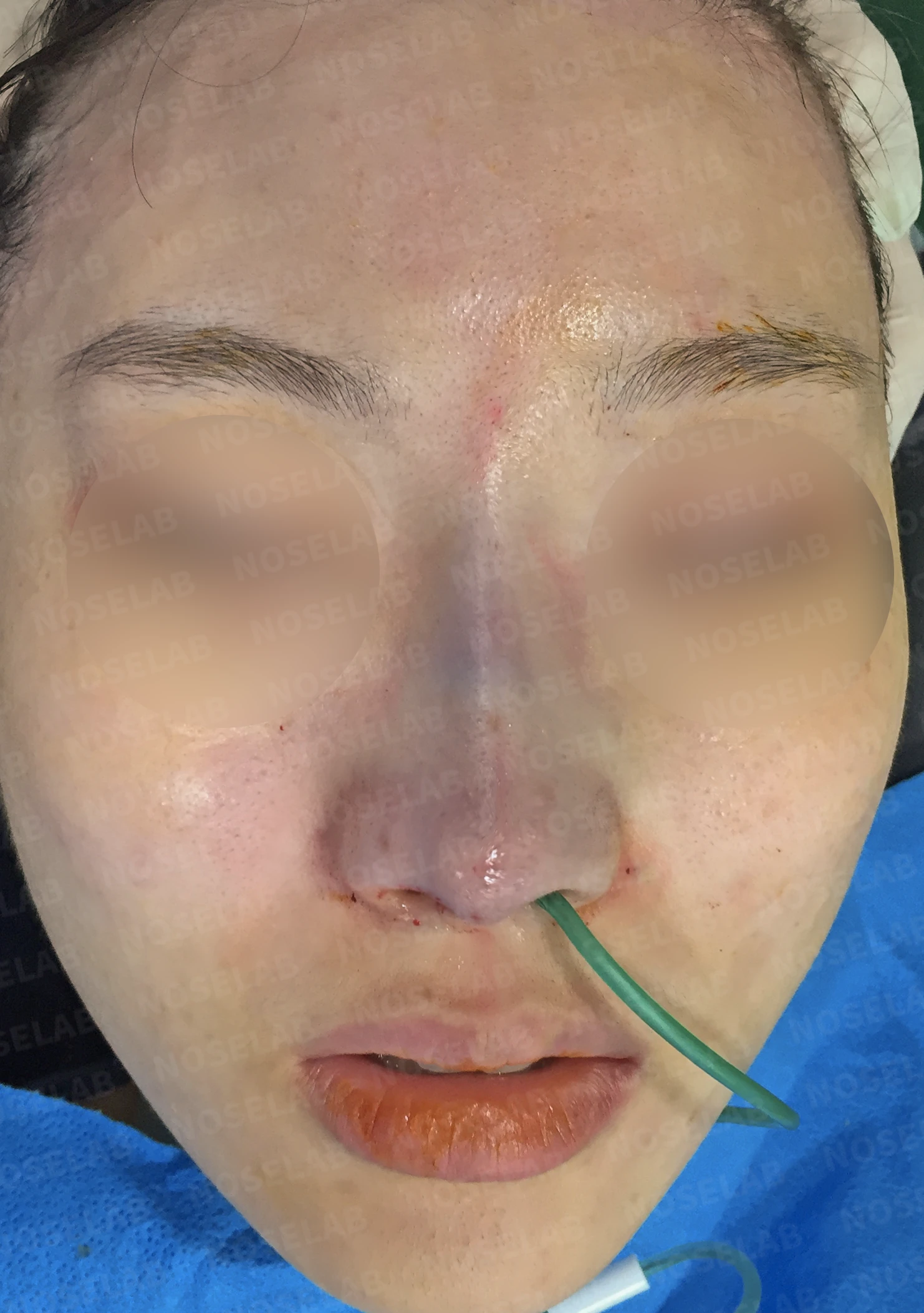매부리코에 코의 휨과 비공 비대칭이 함께 오는 이유, 비중격 연골 교정은 어떻게 하나 — 수술 전 / 수술 직후 0일 직후 사진은 부기가 있는 상태로 최종 결과와 다를 수 있습니다.