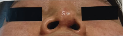 콧구멍을 막는 종괴가 생기는 이유, 제거와 재건은 어떻게 하나 — 본문 사진 10