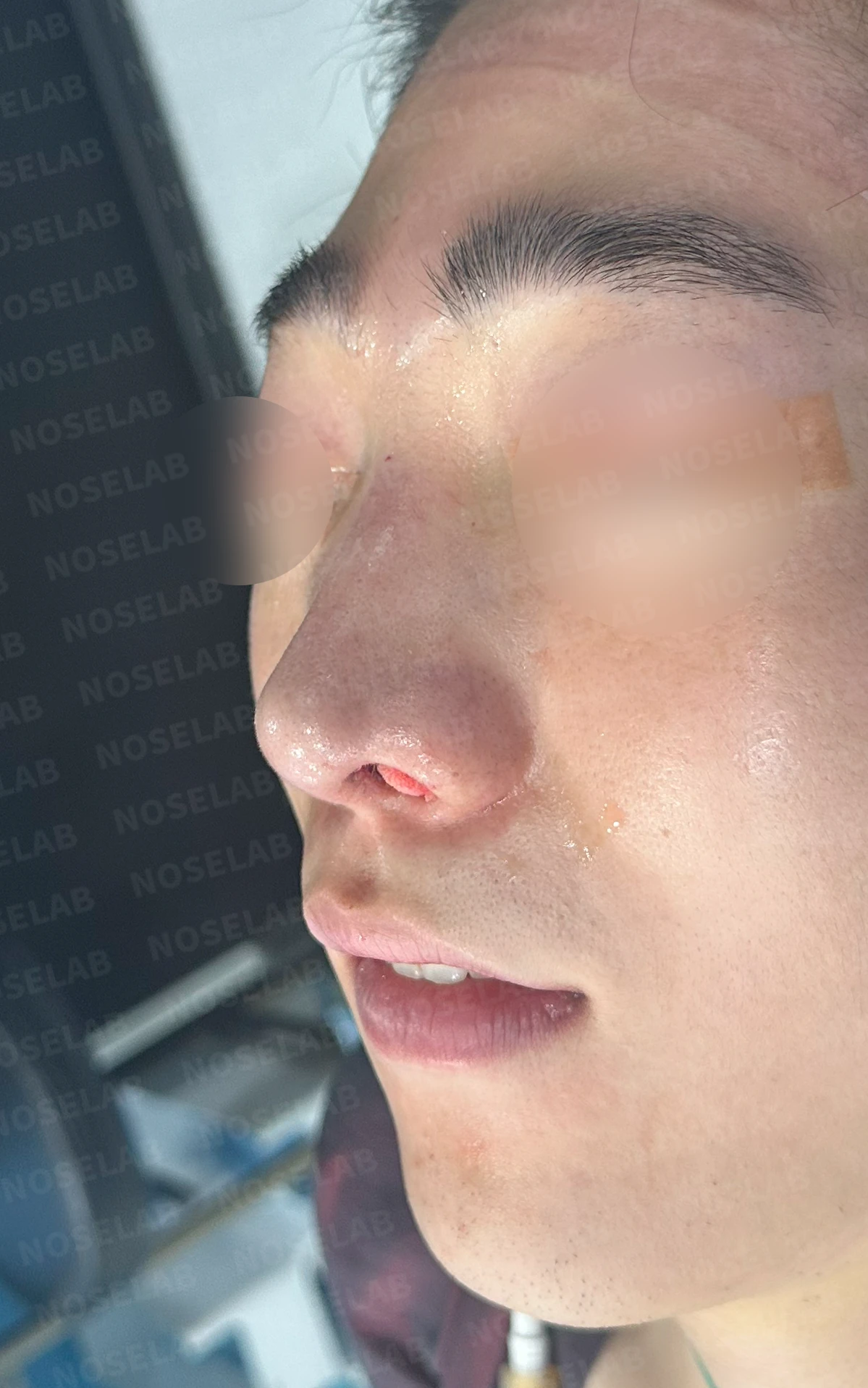코골절과 반복 재수술 뒤 남는 흉터 조직과 비공 비대칭, 재건 방법 — 수술 직후 0일 정면 , 비스듬한 측면 , 측면 사진입니다. 직후 사진은 부기가 있는 상태로 최종 결과와 다를 수 있습니다.