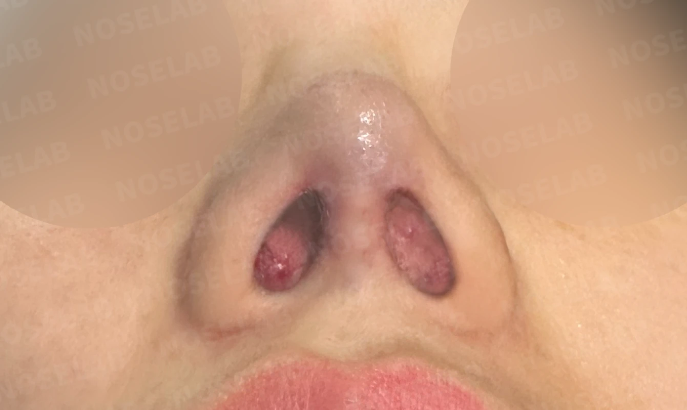메드포어를 넣은 코에 코막힘이 생기는 이유, 제거와 자가늑연골 비중격 재건은 어떻게 하나 — 수술 전 / 수술 직후 0일 직후 사진은 부기가 있는 상태로 최종 결과와 다를 수 있습니다.