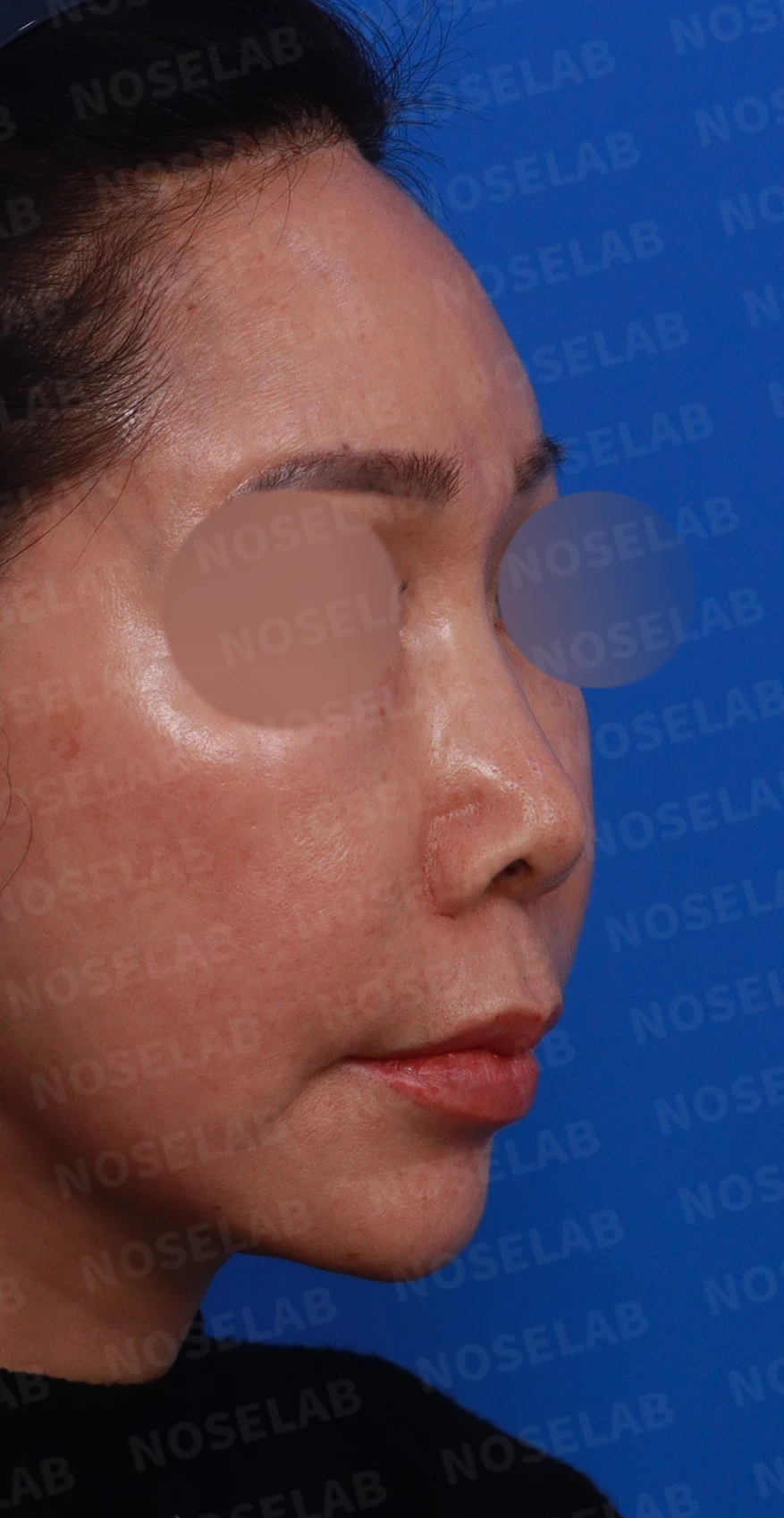 코 안에 남은 메드포어와 이물질, 왜 문제가 되고 어떻게 제거하나 — 디자인 상담 우측 비스듬한 측면, 측면, 비공 사진