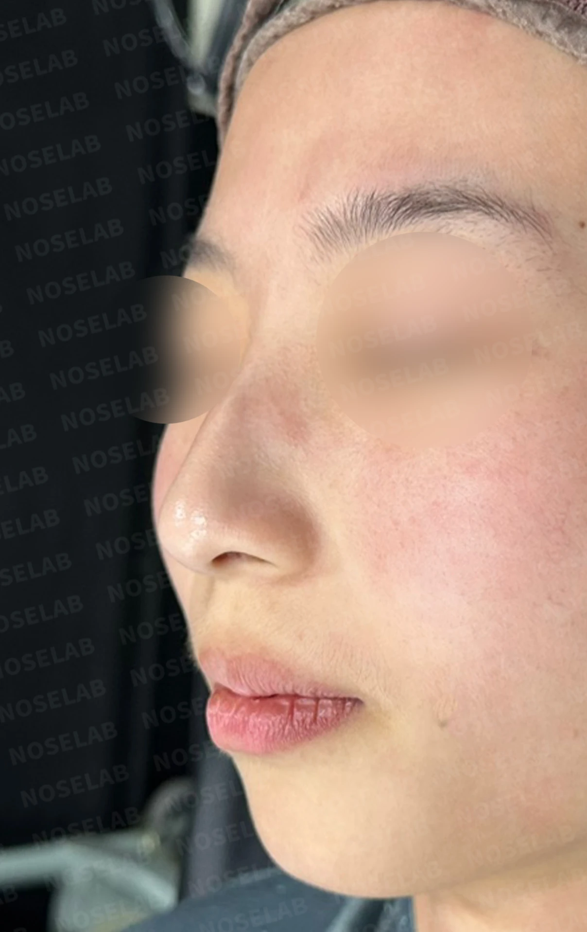 외상 뒤 심해진 매부리와 휜 코, 변화를 최소로 두는 교정 방법 — 수술 전 / 수술 직후 0일 직후 사진은 부기가 있는 상태로 최종 결과와 다를 수 있습니다.
