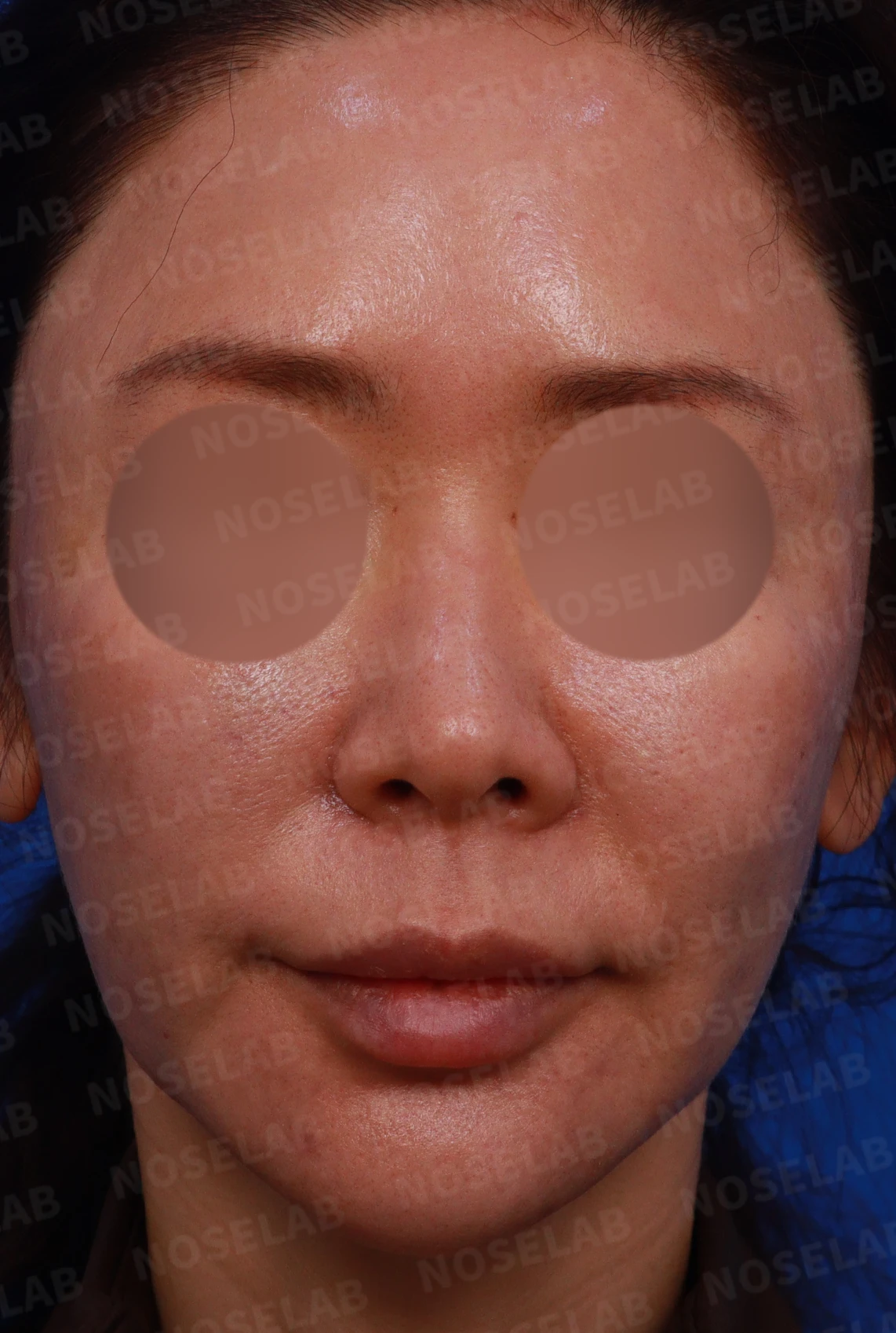 인중 길이와 콧날개 비대칭을 고려한 코 교정 방법 — 디자인 상담 정면, 좌측 측면, 비스듬한 측면 사진입니다.