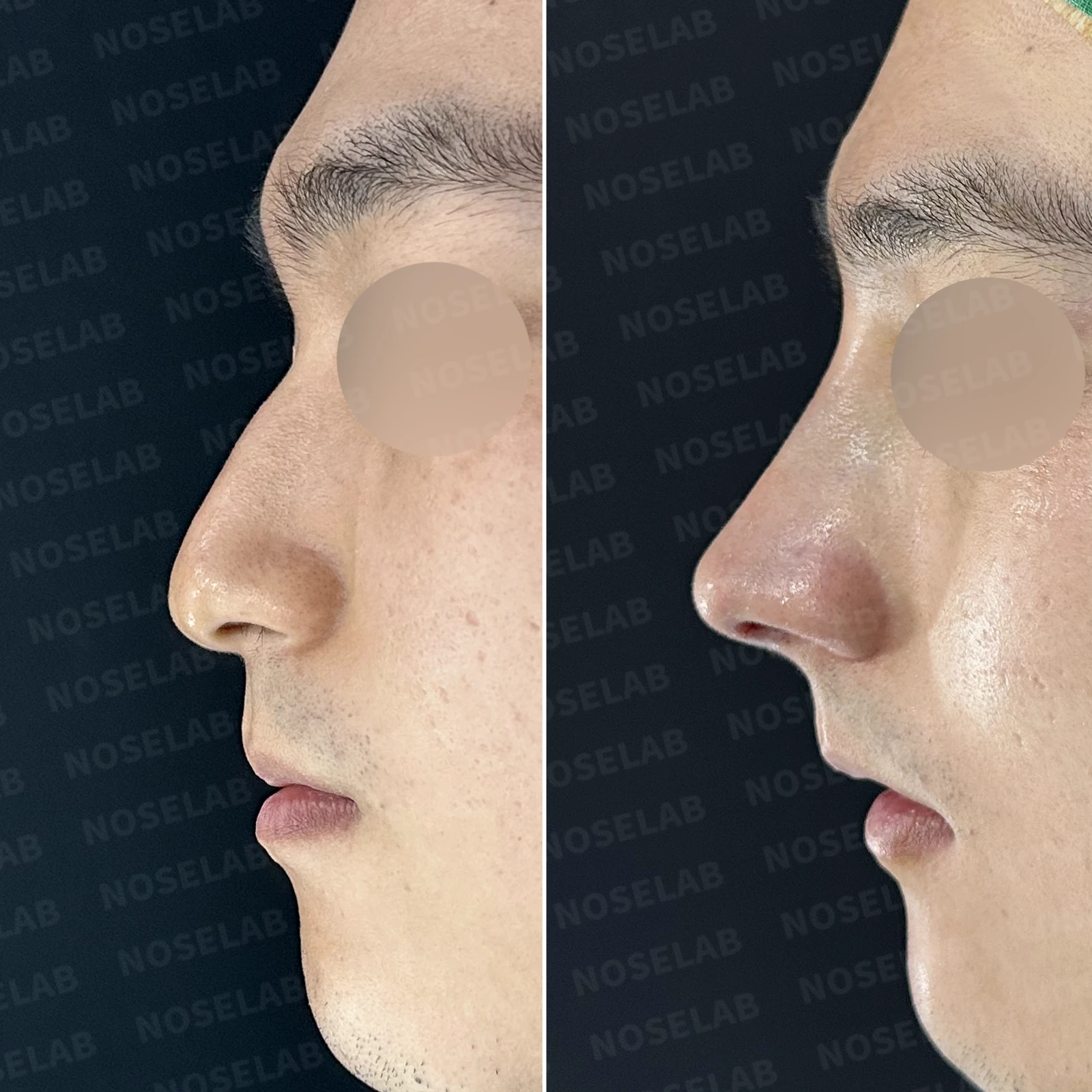 비중격이 휘면 코막힘과 휜 코가 함께 생기는 이유, 재건은 어떻게 하나 — 본문 사진 18