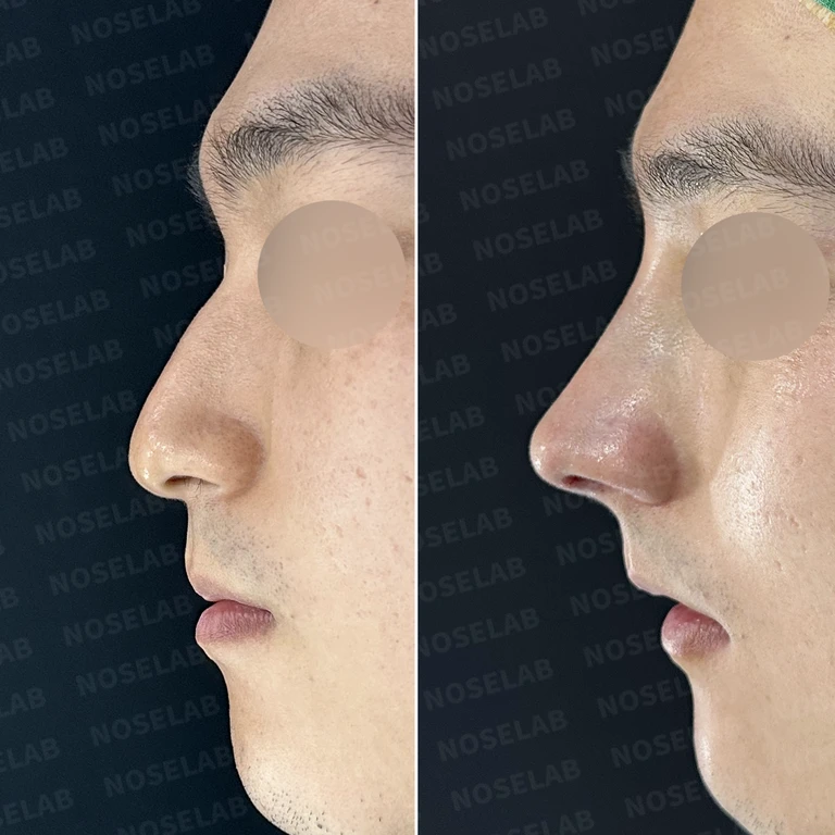 비중격 만곡과 코막힘, 자가늑연골로 기능과 미용 동시 개선 — 전후 비교
