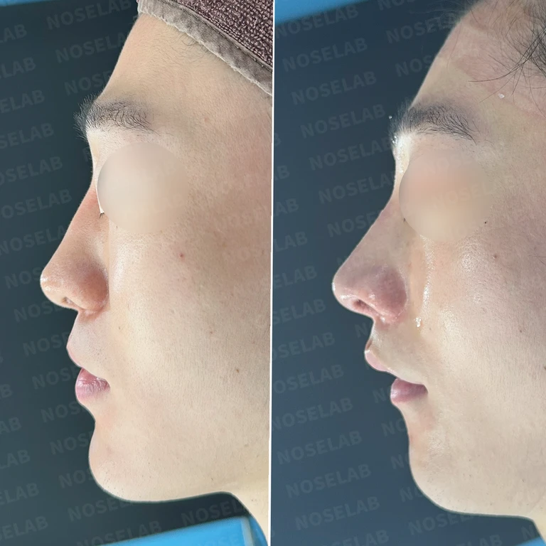 코골절 후 흉터조직과 비공 비대칭, 자가늑연골로 완벽 재건 — 전후 비교