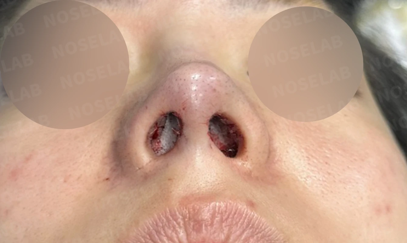 재수술 뒤에도 복코와 퍼진 코끝이 남는 이유, 자가 늑연골 재건은 어떻게 하나 — 수술 직후 0일 비공 사진입니다. 직후 사진은 부기가 있는 상태로 최종 결과와 다를 수 있습니다.
