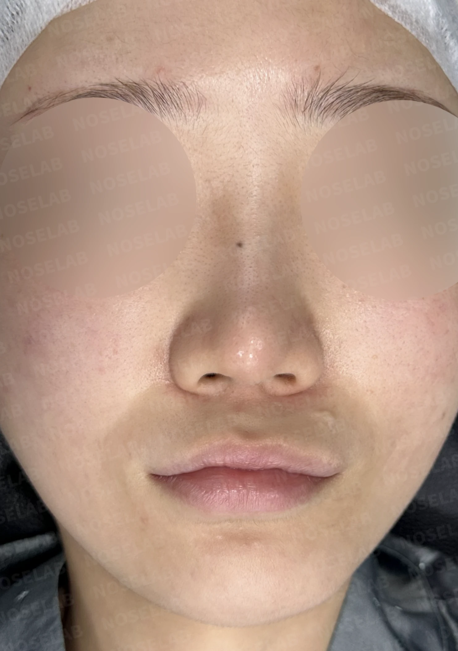 연골 노출 복원과 날개 연골 재건으로 안전하고 자연스러운 코 — 전(좌) , 직후(후)