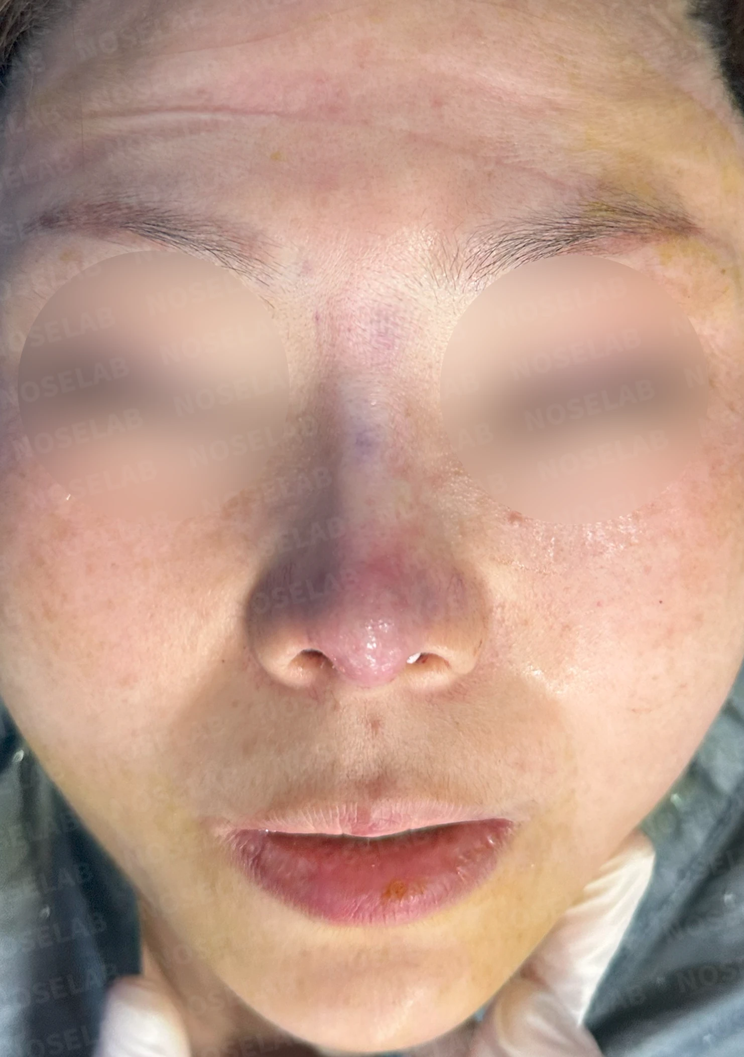 남은 이물질로 인한 염증과 구축코의 교정 방법 — 수술 직후 0일 정면, 측면, 비스듬한 측면 직후 사진은 부기가 있는 상태로 최종 결과와 다를 수 있습니다.
