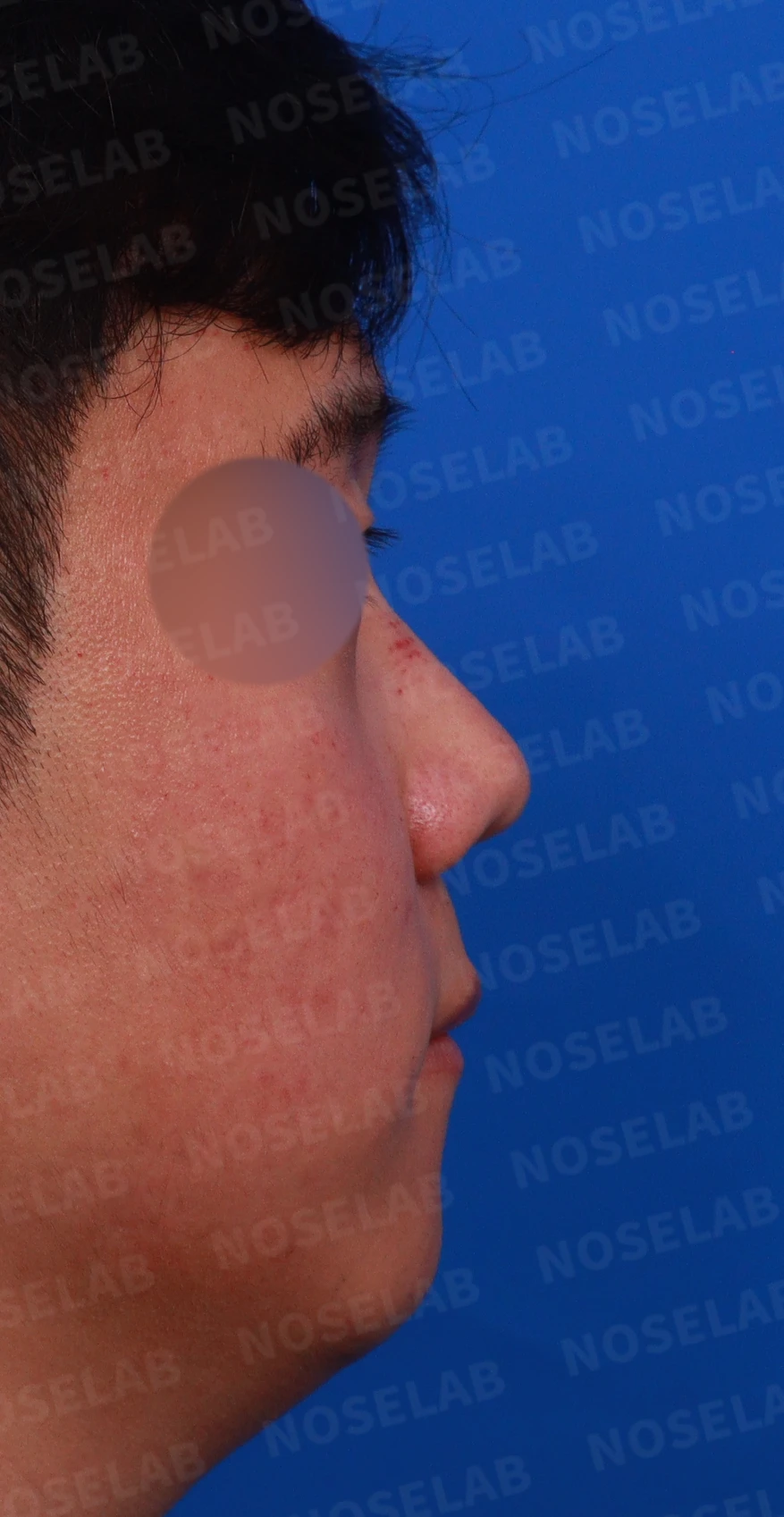 복코와 들린 코, 얼굴 비율을 고려한 교정 방법 — 우측 측면, 비스듬한 측면, 비공 사진