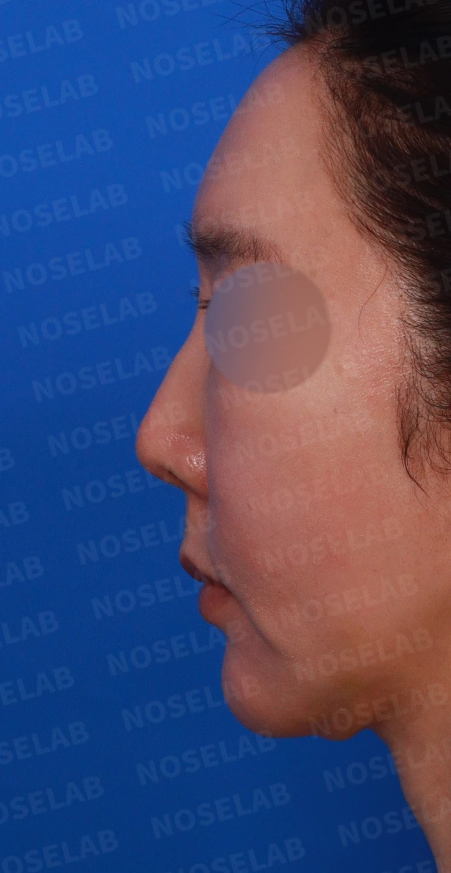 매부리를 깎은 뒤 다시 매부리가 보이고 콧구멍이 드러나는 이유 — 디자인 상담 우측 비스듬한 측면, 측면, 비공 사진