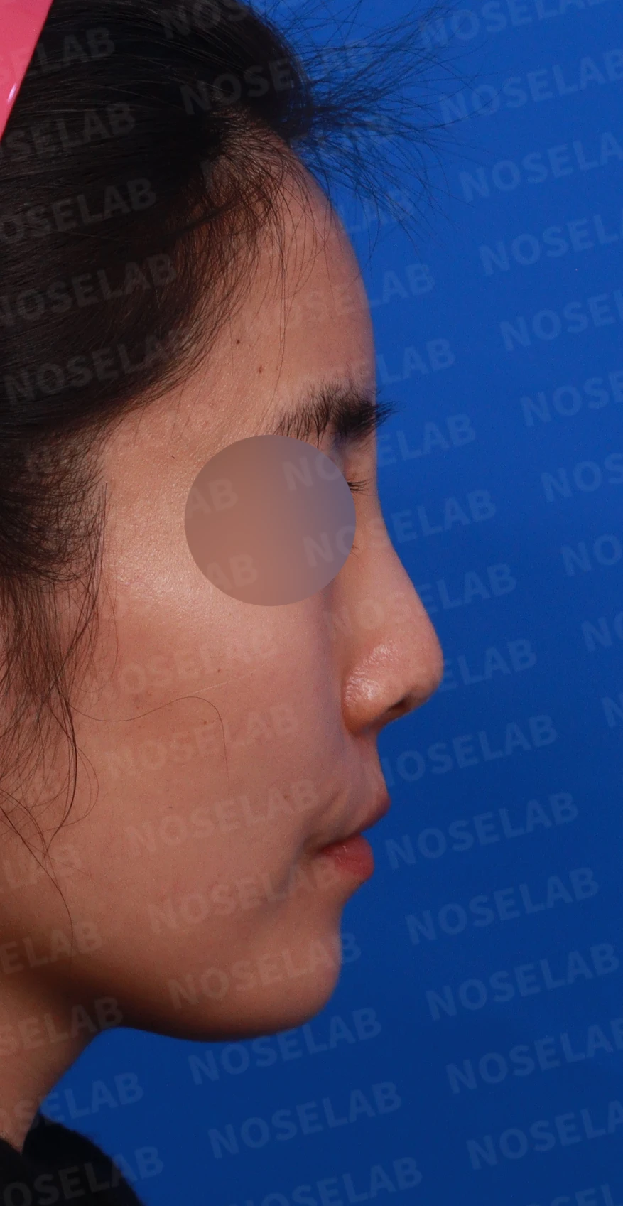 여러 차례 받은 코필러가 남긴 퍼진 코와 코막힘, 어떻게 정리하나 — 디자인 상담 우측 측면, 비스듬한 측면, 비공 사진