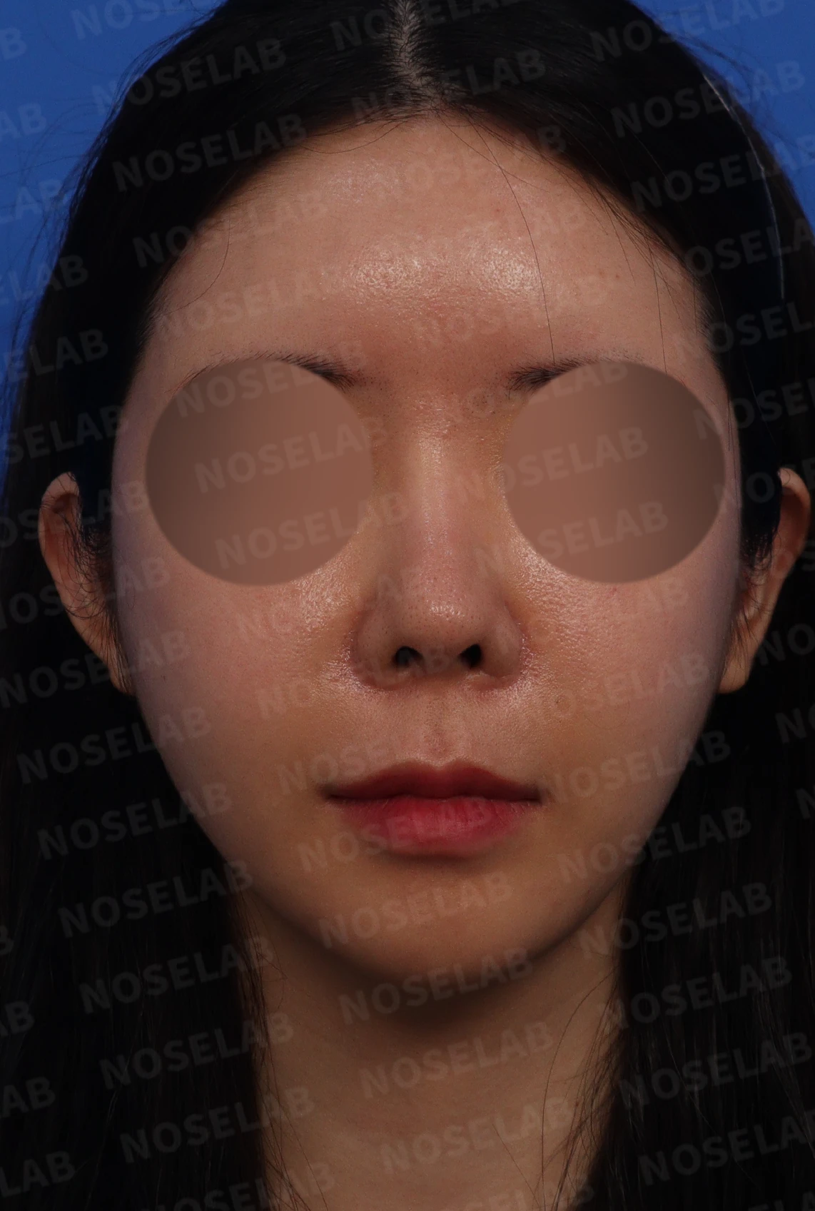 다섯 번의 수술 끝에 찾은 완벽한 코: 들린코와 휜코의 극적인 변신 — 본문 사진 1