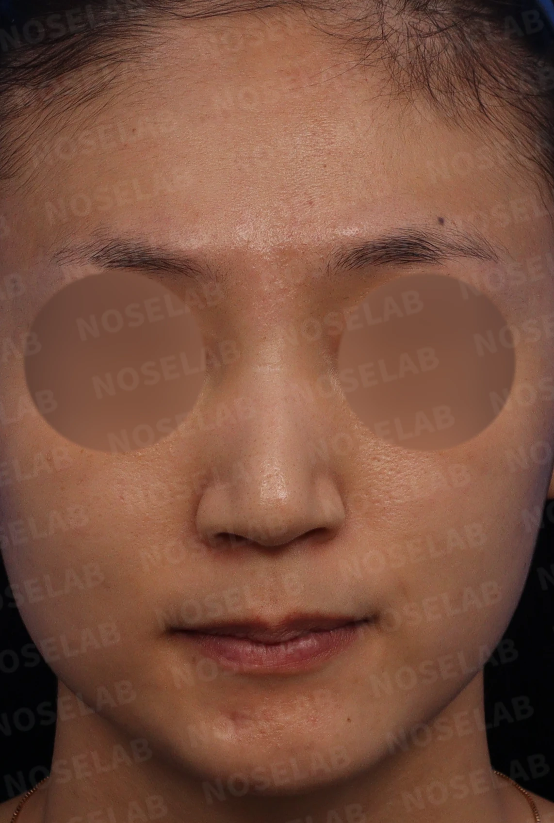 뭉툭한 처진코 교정 방법 — 본문 사진 1