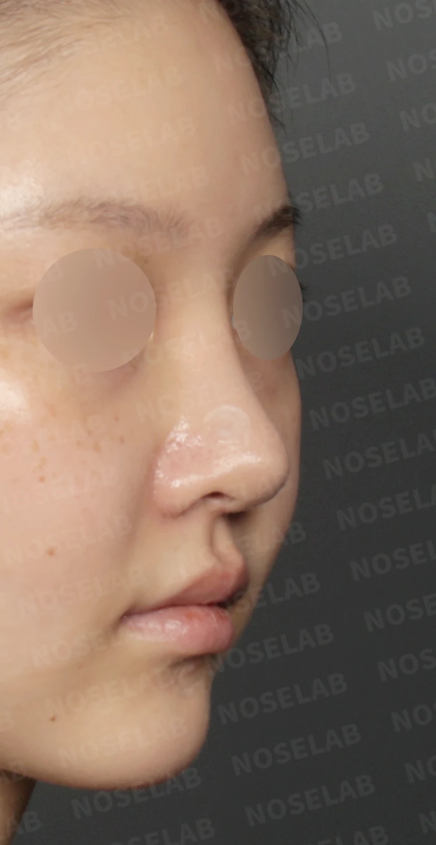 휘어진 코와 복코, 자가늑연골 비중격 재건으로 안전하게 교정한 코재수술 — 디자인 상담 우측 측면, 비스듬한 측면, 비공 사진입니다.