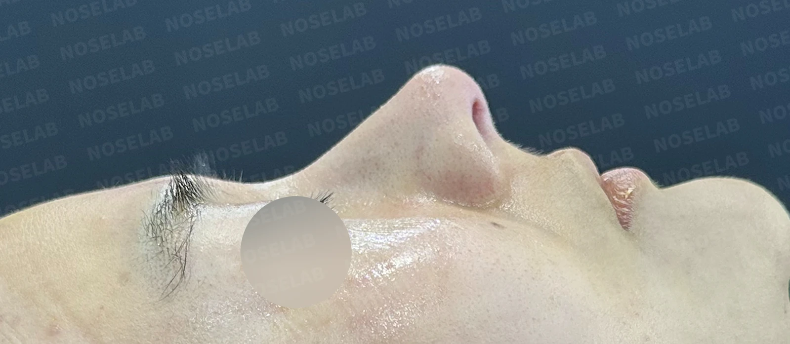 복코 수술은 어떻게 하나요? — 수술 전 / 수술 직후 0일 직후 사진은 부기가 있는 상태로 최종 결과와 다를 수 있습니다.