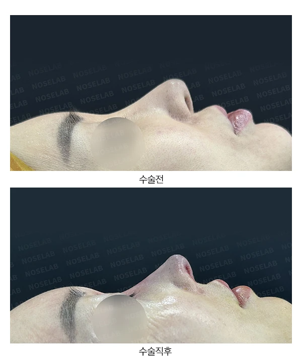 긴코 교정은 어떻게 할까요? — 본문 사진 13