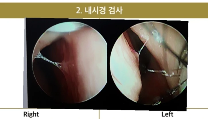 복코 교정과 비주 내리기를 함께 계획하는 방법 — 코 내시경 사진입니다. 비중격연골이 좌측으로 편위 되어 있는 모습을 관찰할 수 있습니다.