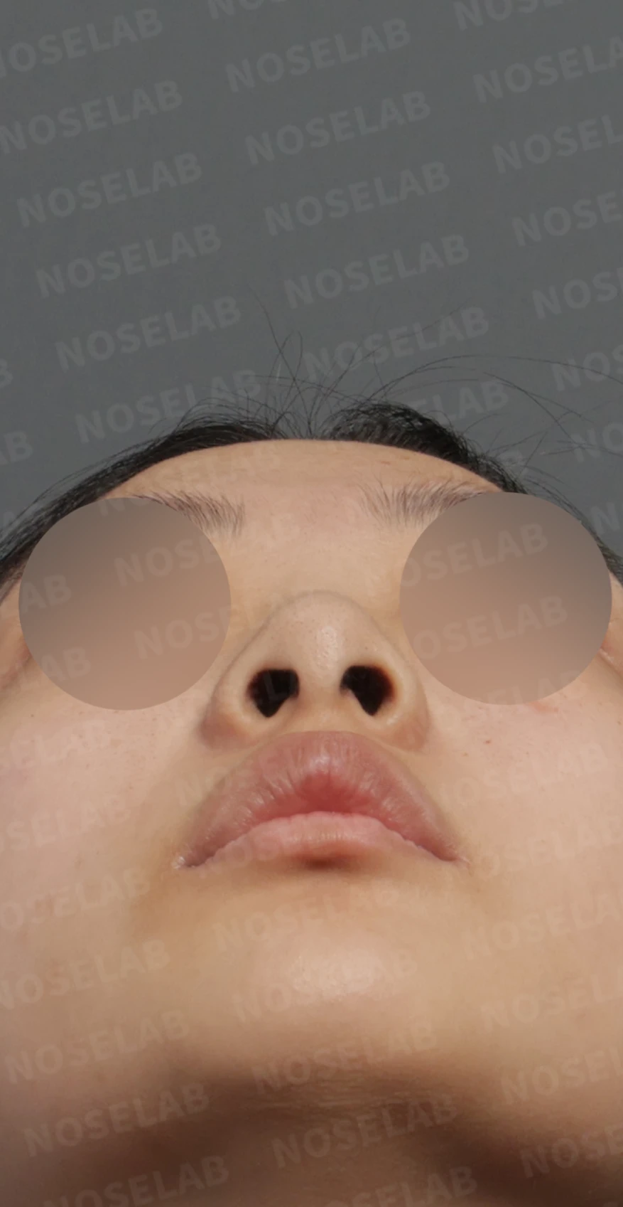 들린 코와 처진 비주, 비중격연장술로 자연스러운 직반라인 완성한 코성형 — 디자인 상담 우측 측면, 비스듬한 측면, 비공 사진입니다.