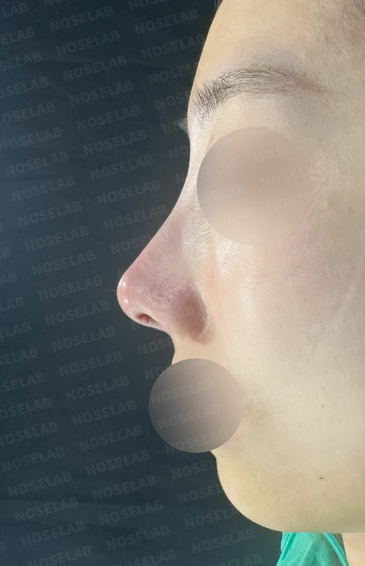 매부리를 정리한 뒤 콧등이 눌려 보이고 코끝이 뭉툭해지는 이유, 보형물 없이 교정하는 방법 — 수술 직후 0일 정면, 측면, 비스듬한 측면 사진 직후 사진은 부기가 있는 상태로 최종 결과와 다를 수 있습니다.