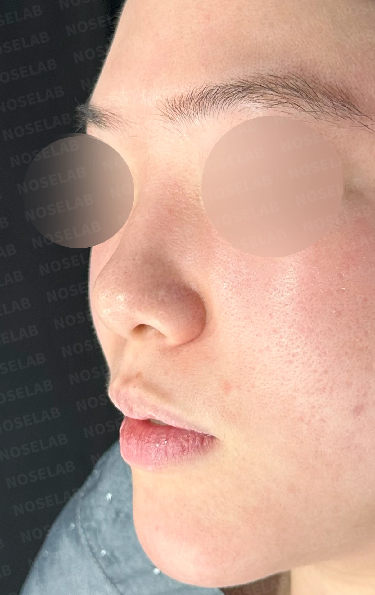 코끝이 퍼지고 입체감이 없어 보이는 이유, 복코 교정은 어떻게 하나 — 수술 전 / 수술 직후 0일 직후 사진은 부기가 있는 상태로 최종 결과와 다를 수 있습니다.