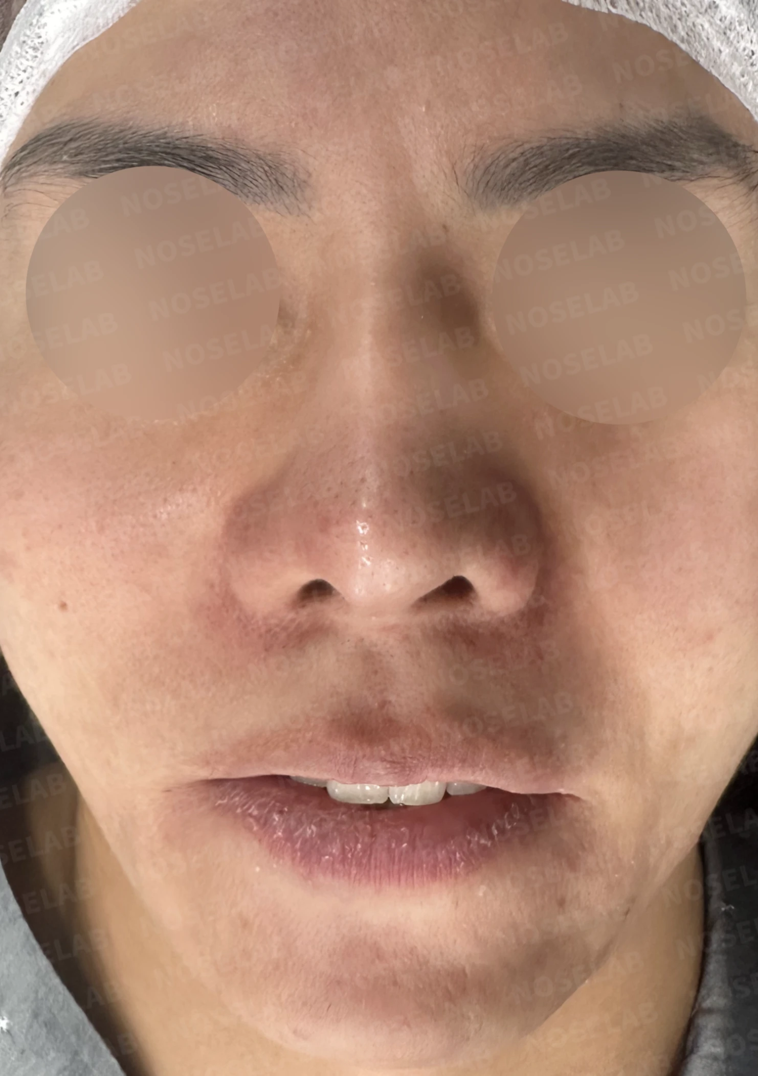 코재수술과 코막힘 교정, 기능과 심미 모두 잡은 비개방 코성형 사례 — 전(좌) 직후(후)
