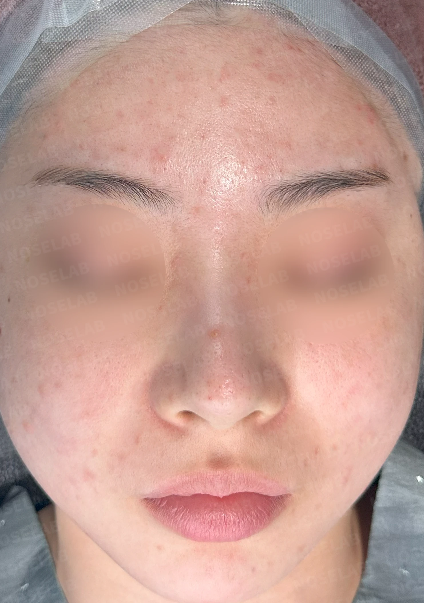 코에 주입된 필러와 실을 제거하고 재건하는 방법 — 수술 전 / 수술 직후 0일 직후 사진은 부기가 있는 상태로 최종 결과와 다를 수 있습니다.