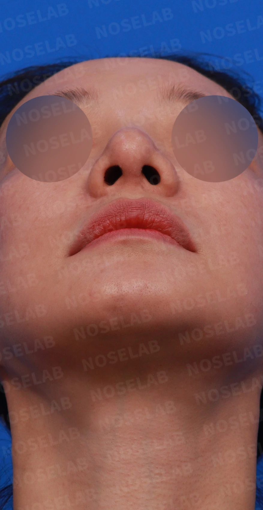 복코와 휜코의 구조를 살펴보는 교정 방법 — 디자인 상담 우측 비스듬한 측면, 측면, 비공 사진입니다.