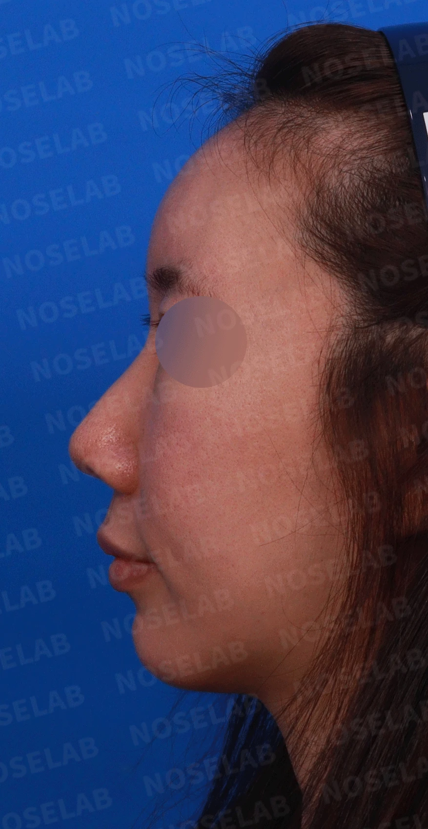 오래된 코 수술 뒤 비주가 함몰되고 코끝이 뭉툭해지는 이유와 재건 방법 — 디자인 상담 정면, 좌측 비스듬한 측면, 측면 사진