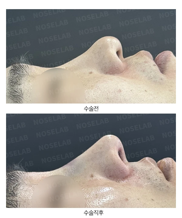 화살코, 휜코 교정 방법 — 전후 비교