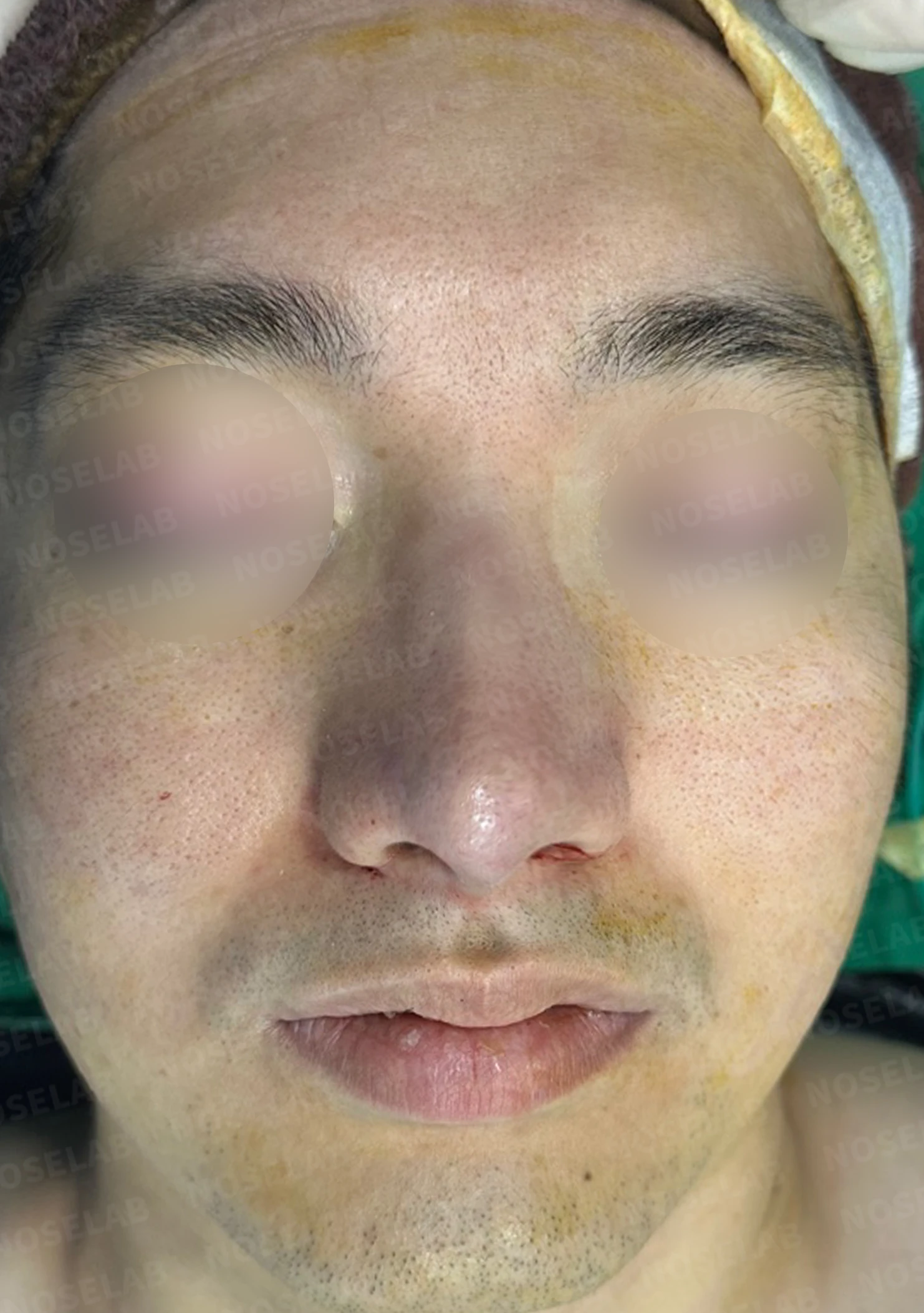 매부리코에 코막힘이 함께 오는 이유, 자가 늑연골만으로 하는 교정 방법 — 수술 직후 0일 정면, 측면, 비스듬한 측면 사진입니다. 직후 사진은 부기가 있는 상태로 최종 결과와 다를 수 있습니다.